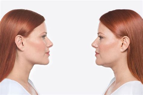 Double Chin Or Submental Fullness — True Skin Cosmetic And Laser Clinic