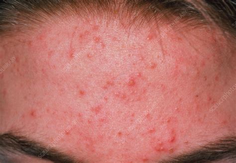 Acne Vulgaris On The Forehead Of A Young Patient Stock Image M108