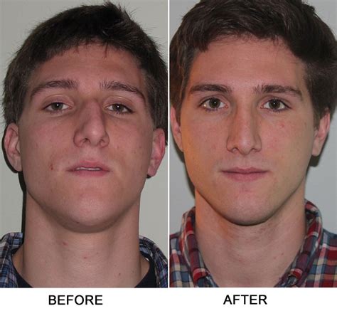 Turbinate Reduction Septoplasty Sinus Surgery Before And After