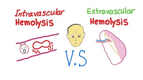 Intravascular Vs Extravascular Hemolytic Anemia Whats The Actual
