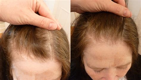 Female Pattern Baldness Receding Hairline