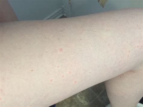 Gérer Chemisier Contribution Tiny Itchy Bumps On Legs Je Mange Le Petit