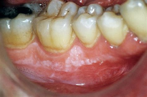 Leukoplakia Of The Gums Photograph By Cnri