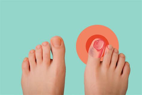Ingrown Toenail Symptoms Causes Treatment And Prevention