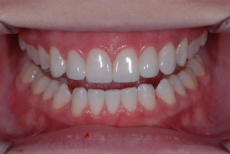 Teeth Treat Before And After Teeth Whitening At Dentist