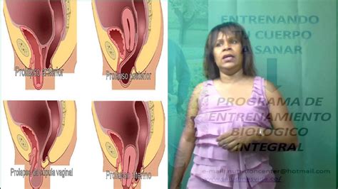 Todo Sobre Prolapso Vaginal Dolor Y Pesadez En El Area Vaginal Youtube