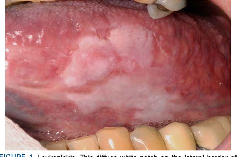 Squamous Cell Carcinoma Of Mouth Semantic Scholar