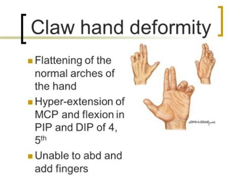 Ulnar Nerve Injury Claw Hand