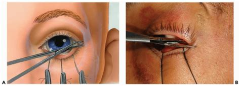 Transconjunctival Approaches Pocket Dentistry