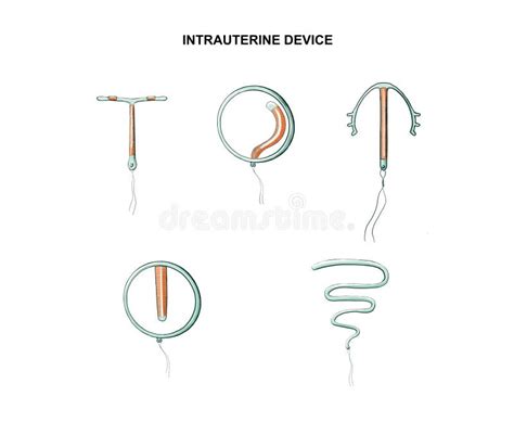Intrauterine Spiral Stock Vector Illustration Of Method 19848903