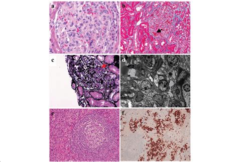 Histopathological Findings In Renal And The Inguinal Lymph Node