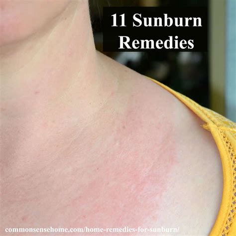 11 Home Remedies For Sunburn Relief To Get Rid Of Sunburn