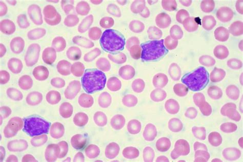Leukemia Definition Causes Symptoms And Treatment Britannica