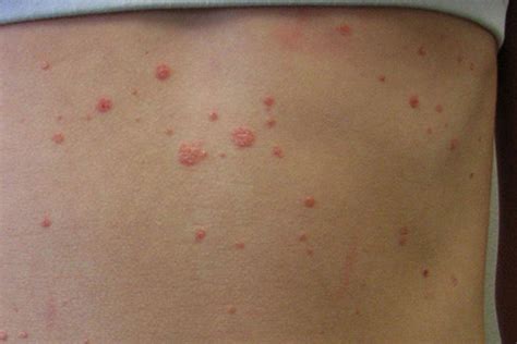 Psoriasis In Children Symptoms Types How To Deal With It 46 Off