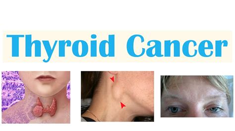Thyroid Cancer Papillary Follicular Medullary And Anaplastic