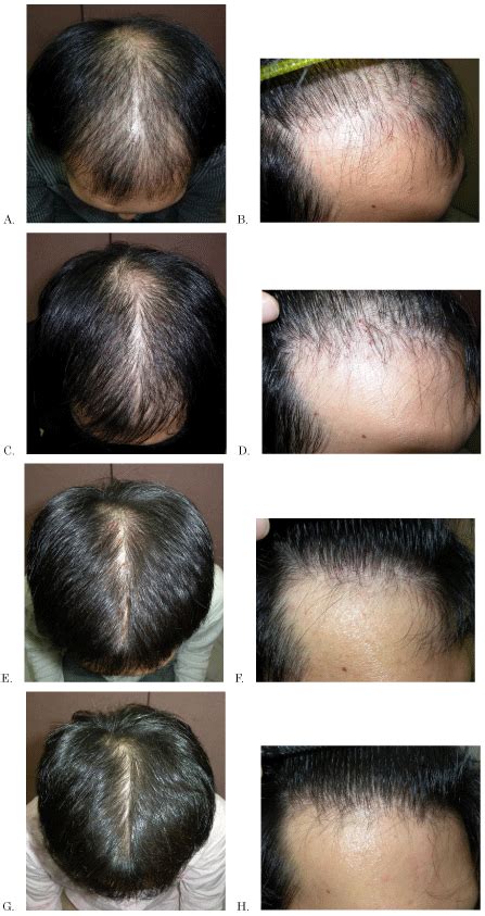 Finasteride For Hair Loss Results Propecia Finasteride Hair