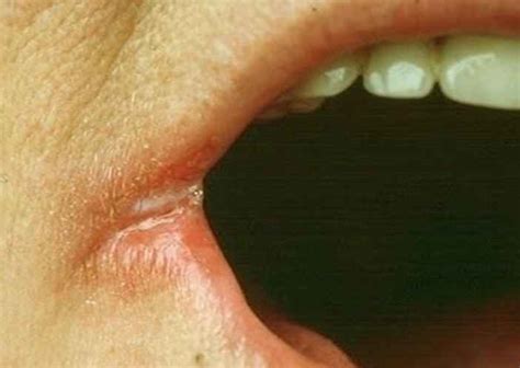 Sore In Corner Of Mouth Causes Treatment Pictures Healing