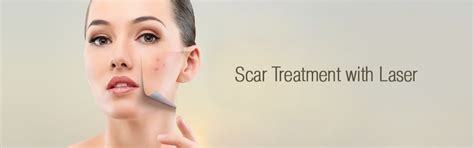 Scar Treatment With Laser Spanish Center Dubai