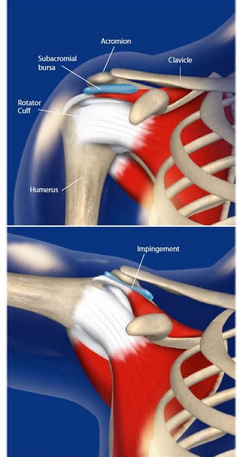 Shoulder Impingement Shoulder Impingement Syndrome Physical Therapy