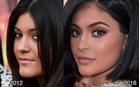 Kylie Jenner Before And After All Of Her Plastic Surgery