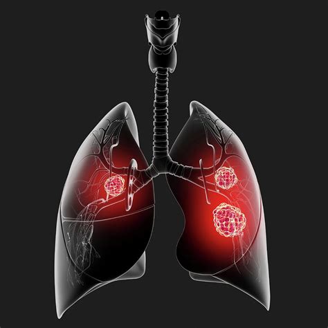Lung Cancer Photograph By Pixologicstudioscience Photo Library