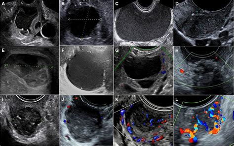 Clinical And Ultrasound Characteristics Of Vaginal Lesions