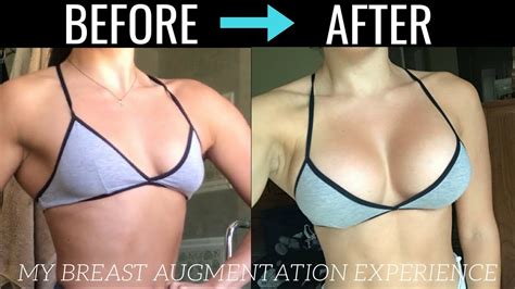 My Breast Augmentation Experience Process Recovery Details Youtube