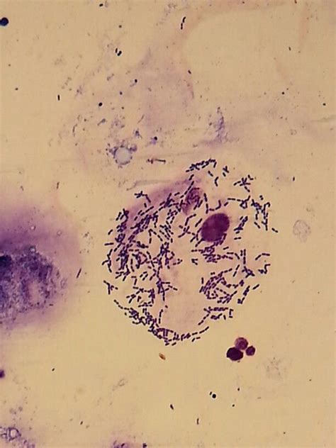 Gram Positive Streptococci Covering A Squamous Epithelial Cell From My