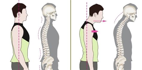 How To Fix Forward Head Posture 3 Stretching Exercises To Try