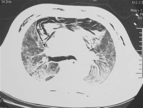 Chest Computed Tomography Showed Bilateral Diffuse Ground‑glass