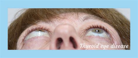 Homepage Thyroid Eye Disease