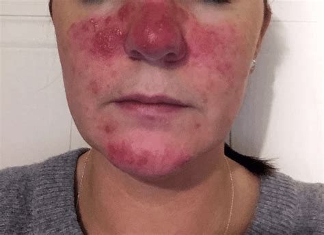 Study Medical Photos A 45 Year Old Woman Presents With A Red Rash On