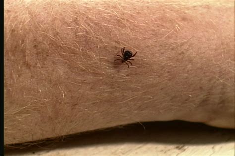 Tick Bite Symptoms For Humans And Disease Info