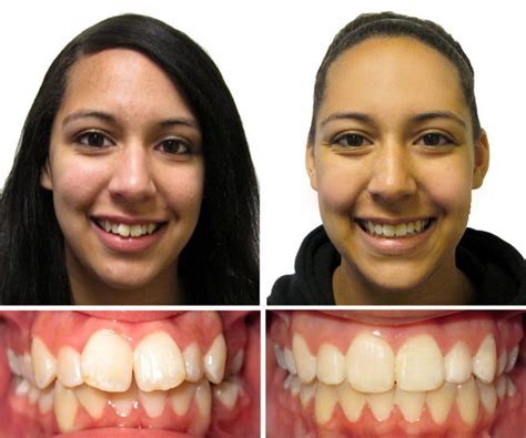 Also, as far as candy. Braces Before and After | Children & Family Dentistry & Braces