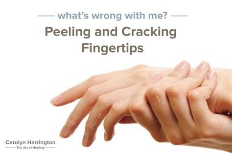 What Is The Cause Of My Cracked Peeling Fingertips Artofit