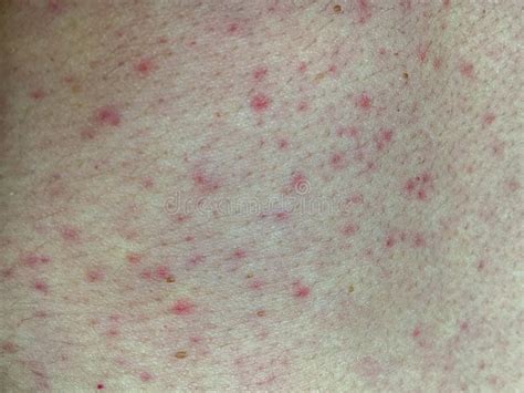 Close Up Of Skin Red Rash On Woman Belly Stock Image Image Of Allergy