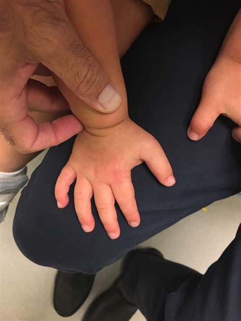 Extra Thumb Reconstruction Congenital Hand And Arm Differences