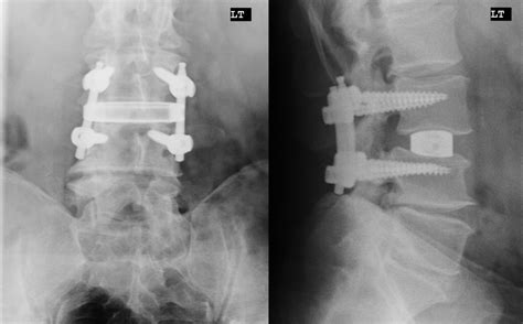 Lateral Interbody Fusion Treatment In Nj Comprehensive Spine Care