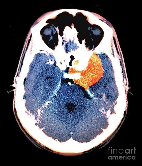 Meningioma Brain Tumour Photograph By Zephyrscience Photo Library