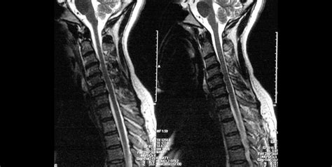 Cervical Spinal Stenosis Dr Dan Heffez Neurological Surgeon