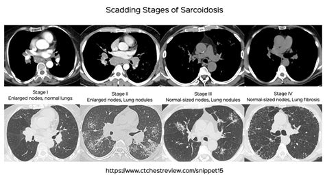 Sarcoidosis Ct Chest Review