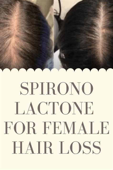 Spironolactone For Female Hair Loss Hair Loss Remedies Hair Loss