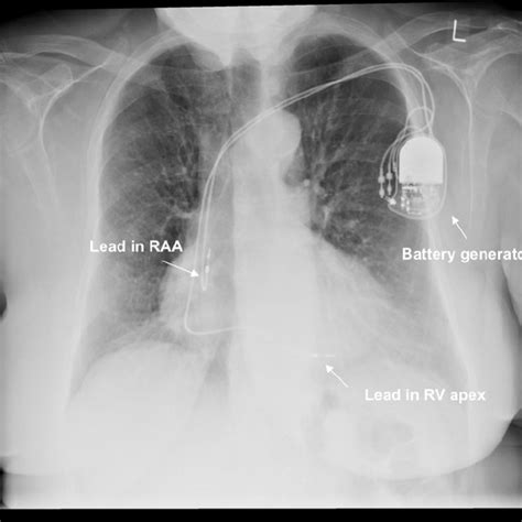 Dual Chamber Pacemaker Seen On Chest Radiograph Raa Right Atrial