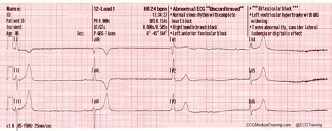 Bifascicular Blocks What You Need To Know Ecg Medical Training