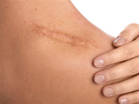 Scars Simply Skin Boutique Scars Form During Skins Healing Process