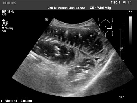 Die darmlähmung ist ein paralytischer ileus. Ultraschall des Darms | Universitätsklinikum Ulm
