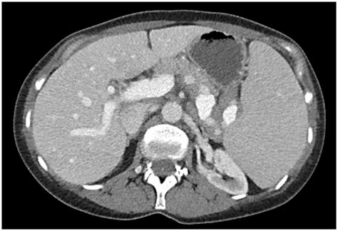 The Patients Abdominal Ct Scan Demonstrates Massive Splenomegaly With