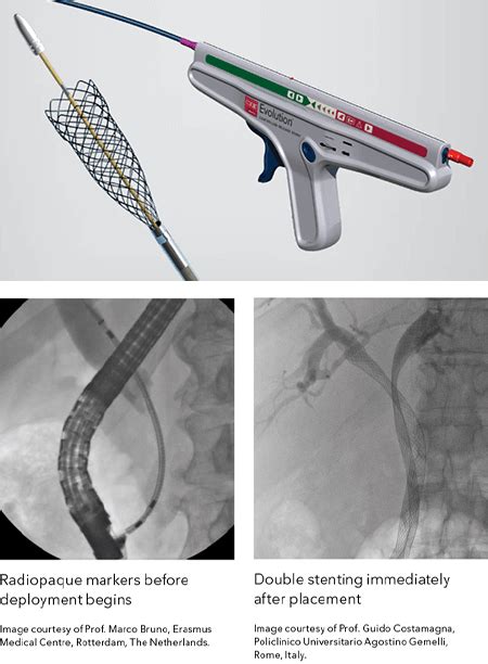 Cook Adds To Their Ever Expanding Portfolio Of Biliary Stents Endoscopy