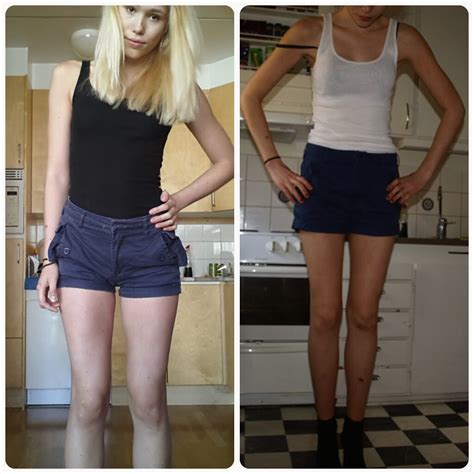 A Life Without Anorexia Progress Photos