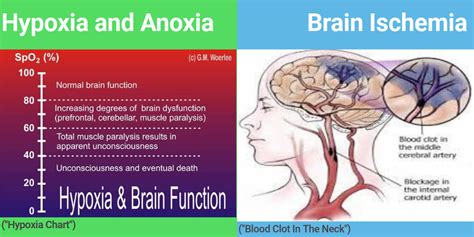 Brain Hypoxia And Anoxia Infographic Infogram